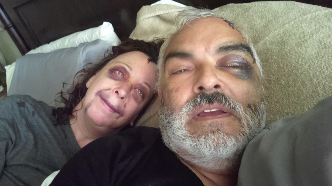 Couple attacked by hammer-wielding burglar share their story of survival - Vimarsana News