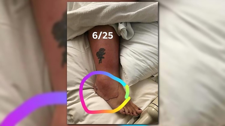 Woman Almost Loses Leg After Nightmare Pedicure
