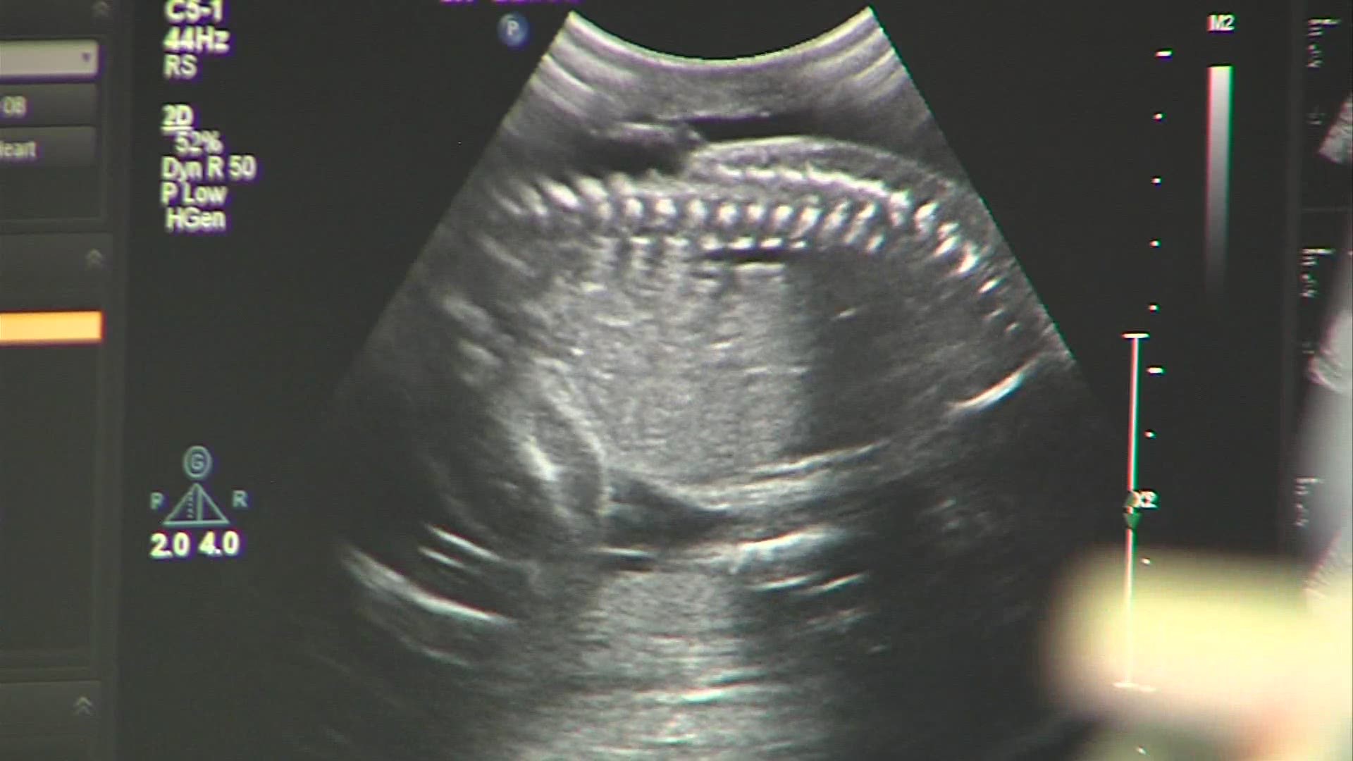 June 19, 2019: The Cleveland Clinic just released this video showing their first-ever successful in utero surgery on a 23-week-old fetus. The operation was done to repair the baby's spina bifida birth defect. The baby was born June 3, a few months after this surgery took place in February.