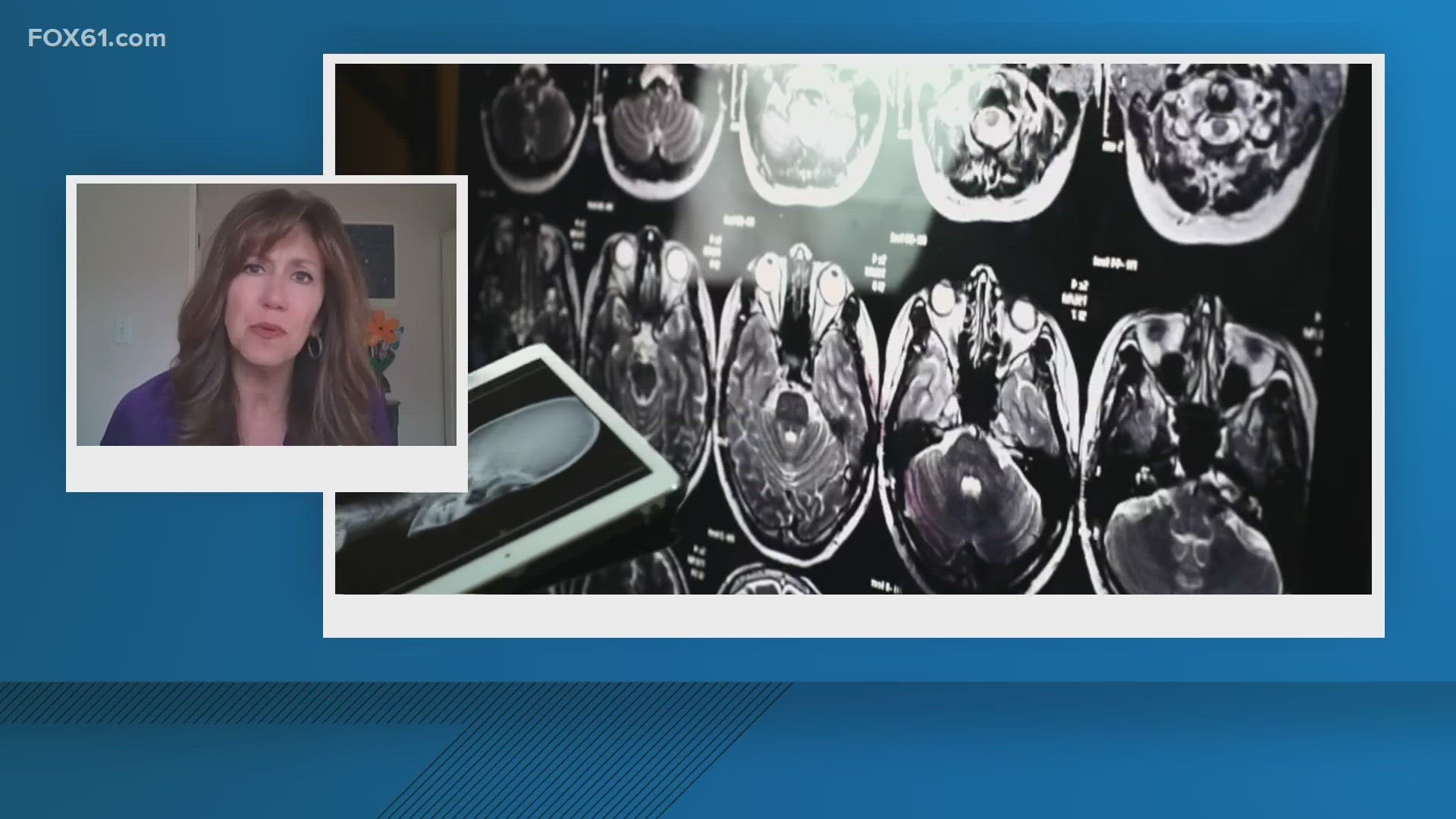 Kristin Cusato with the CT Alzheimer's Association discusses the differences between Alzheimer's and dementia following former first lady Rosalynn Carter's diagnosis