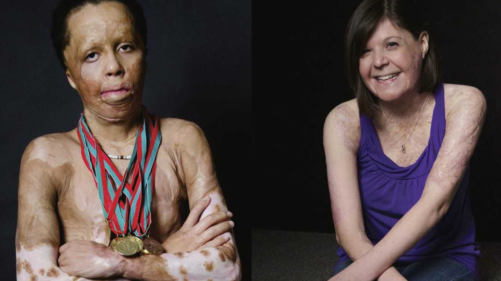 Largo Couple Creates Photo Book Highlighting Proud Scars Of Burn Survivors 2328