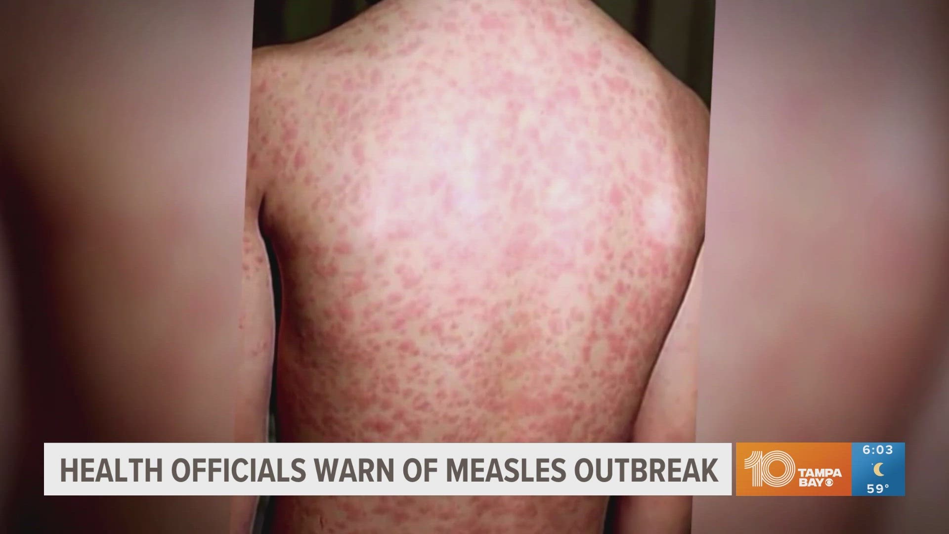 While measles is a highly contagious disease, it is preventable through vaccination.