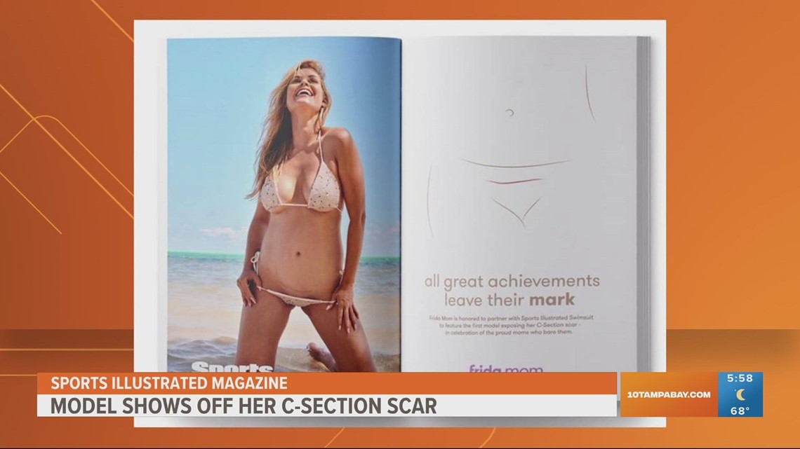 Sports Illustrated Swimsuit to feature first model with C-section scar