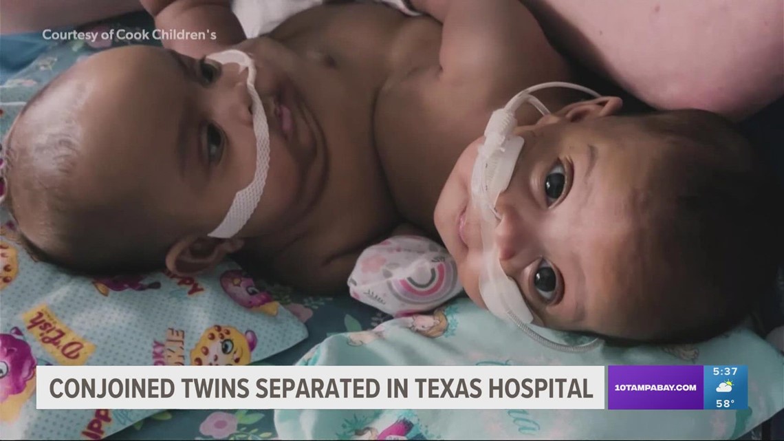 Conjoined twins successfully separated at North Texas hospital