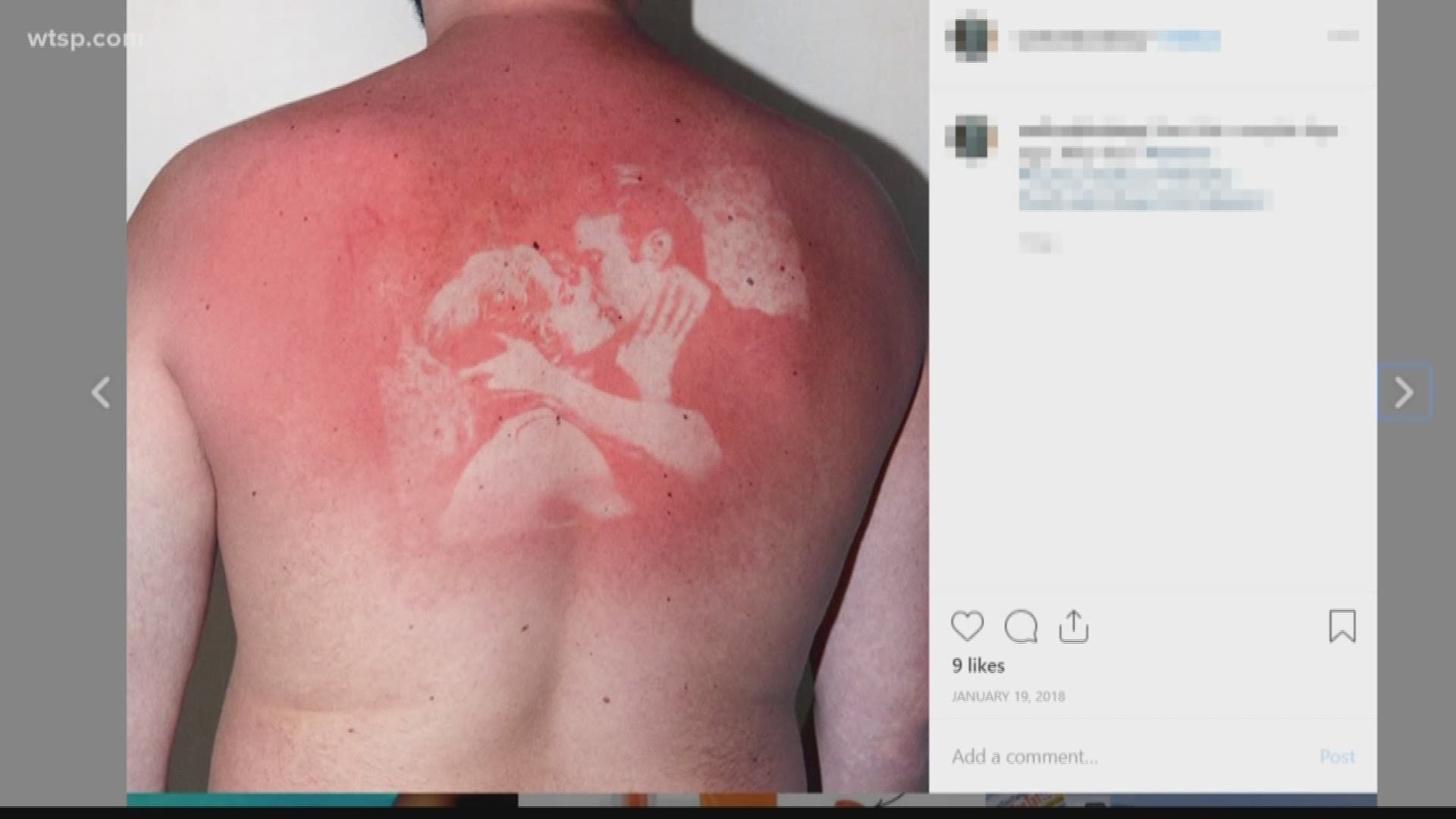 Sunburn art Shocking snaps show people are risking skin cancer to paint  angry red shapes on their bodies  Mirror Online