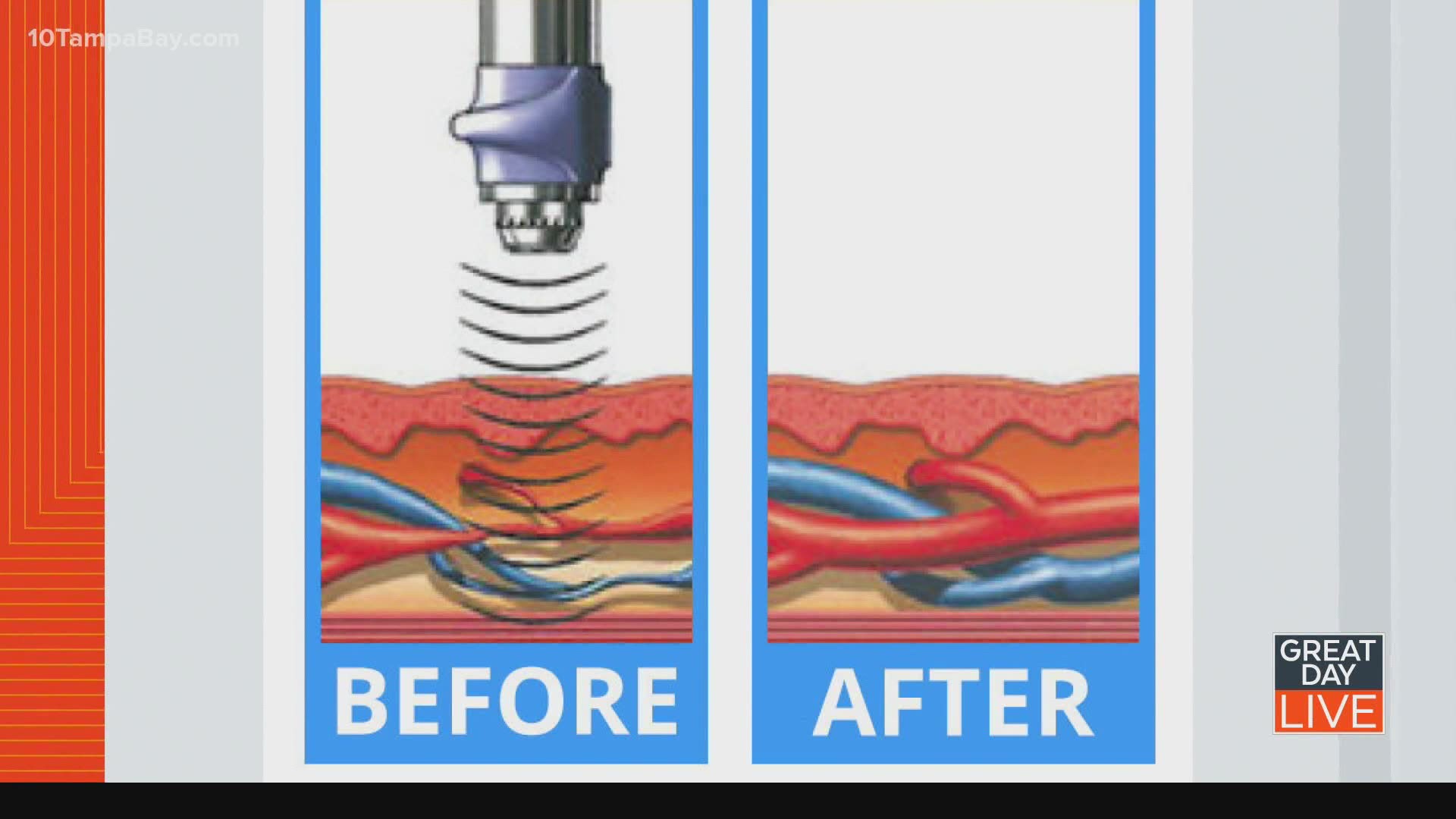 extracorporeal shock wave therapy erectile dysfunction