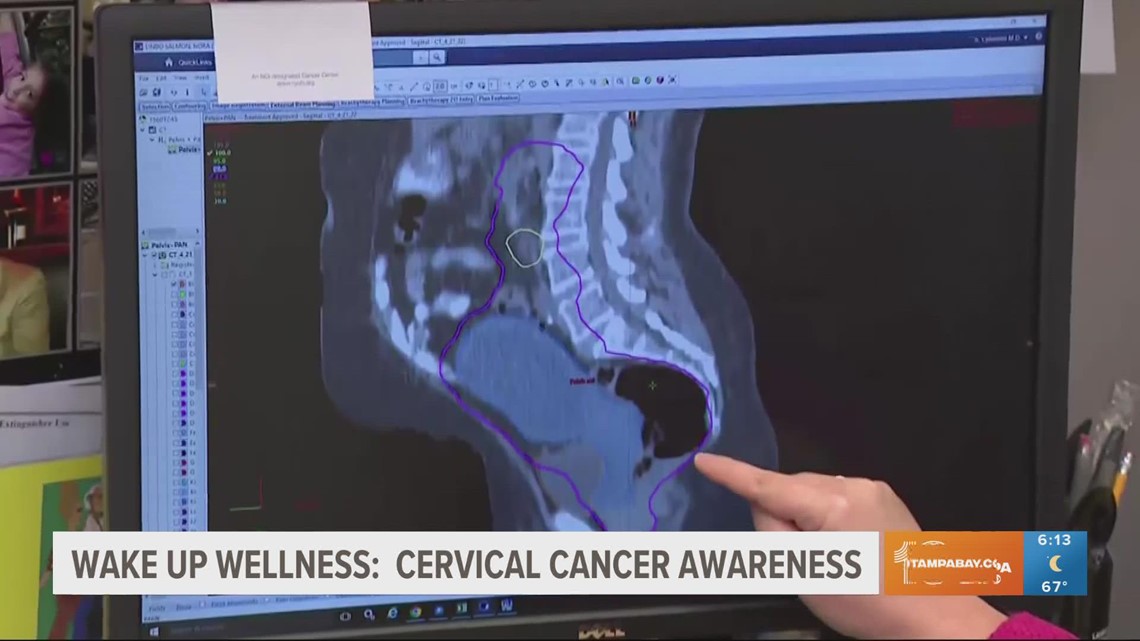 Advanced-stage cervical cancer increasing in the US