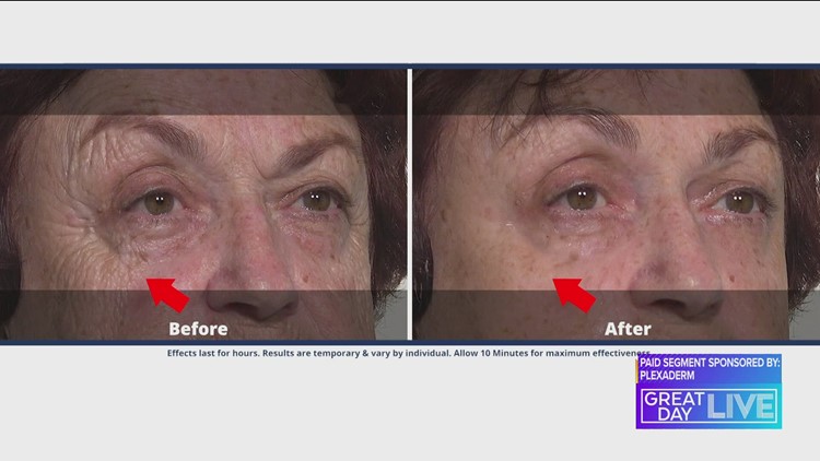 Plexaderm can help erase lines of aging during this summer.