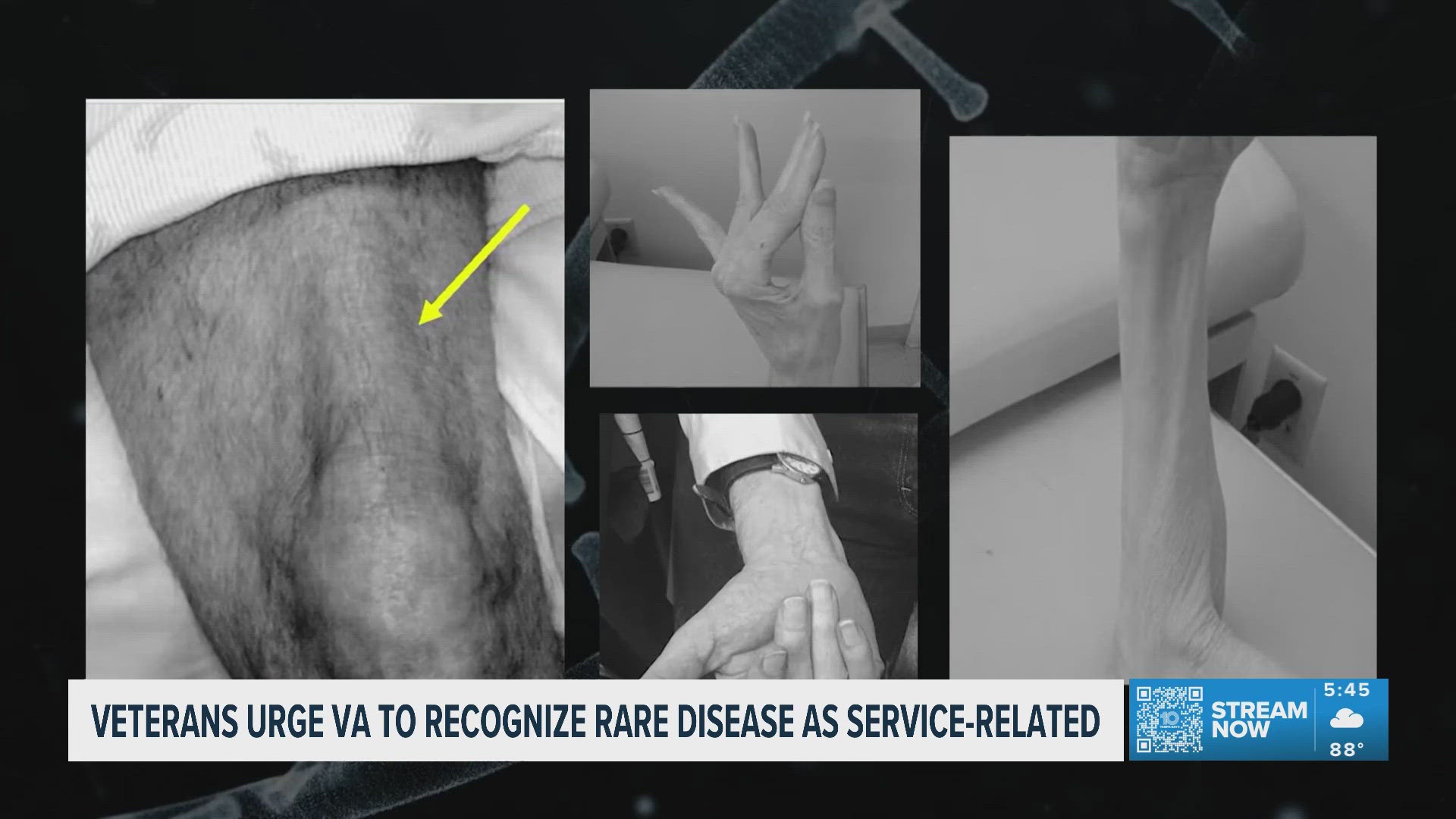 Diagnosis Denied: Veterans urge the VA to recognize rare muscle disease ...