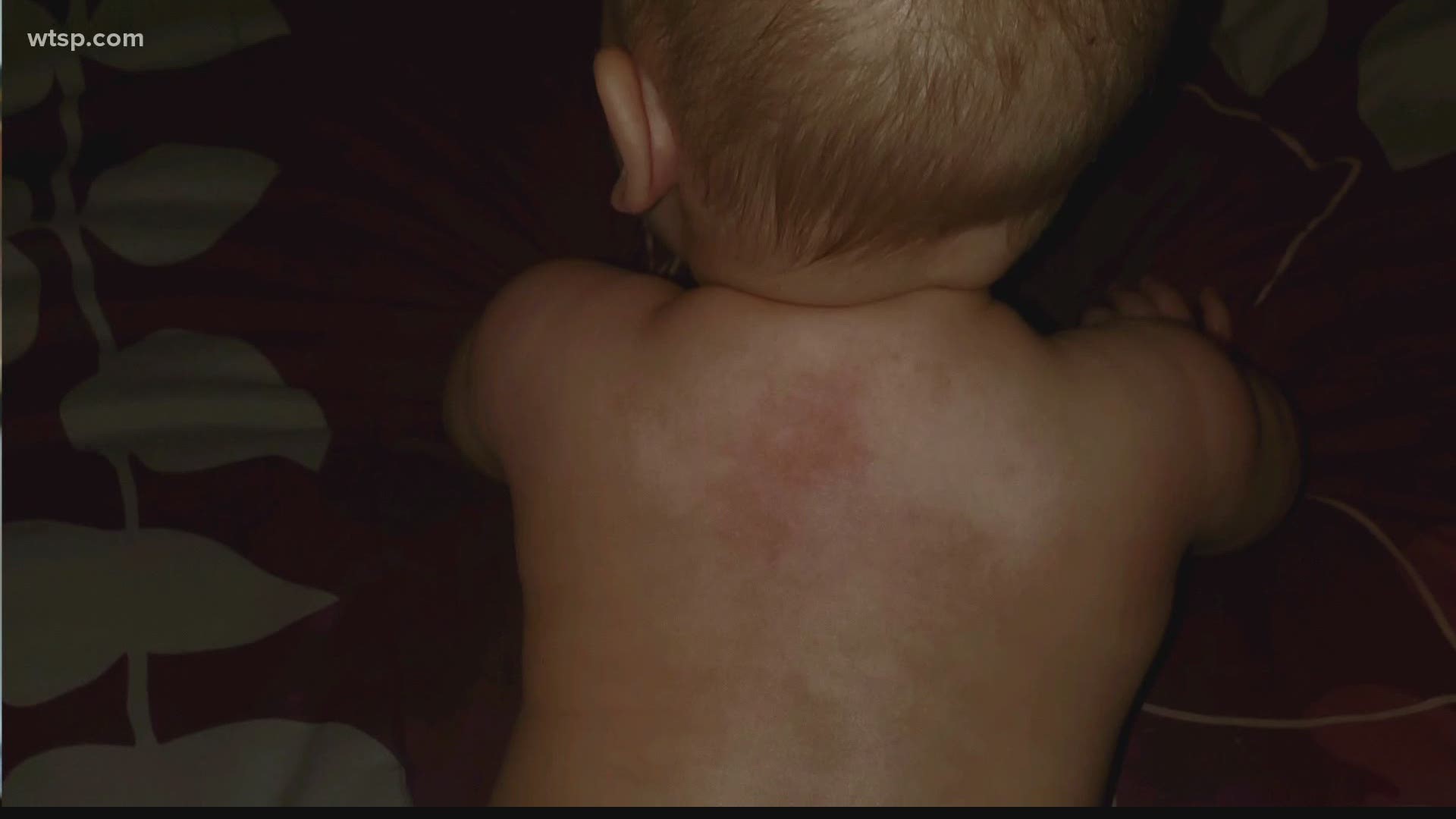 Rash On Baby With Coronavirus Could Be Another Disease Wtsp Com