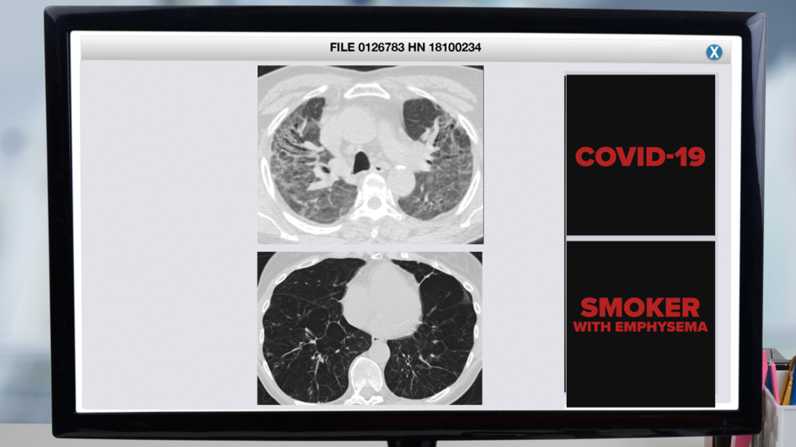 'We've never seen this before': Pulmonologists say lung scans show devastating impacts from COVID-19 - WTSP.com