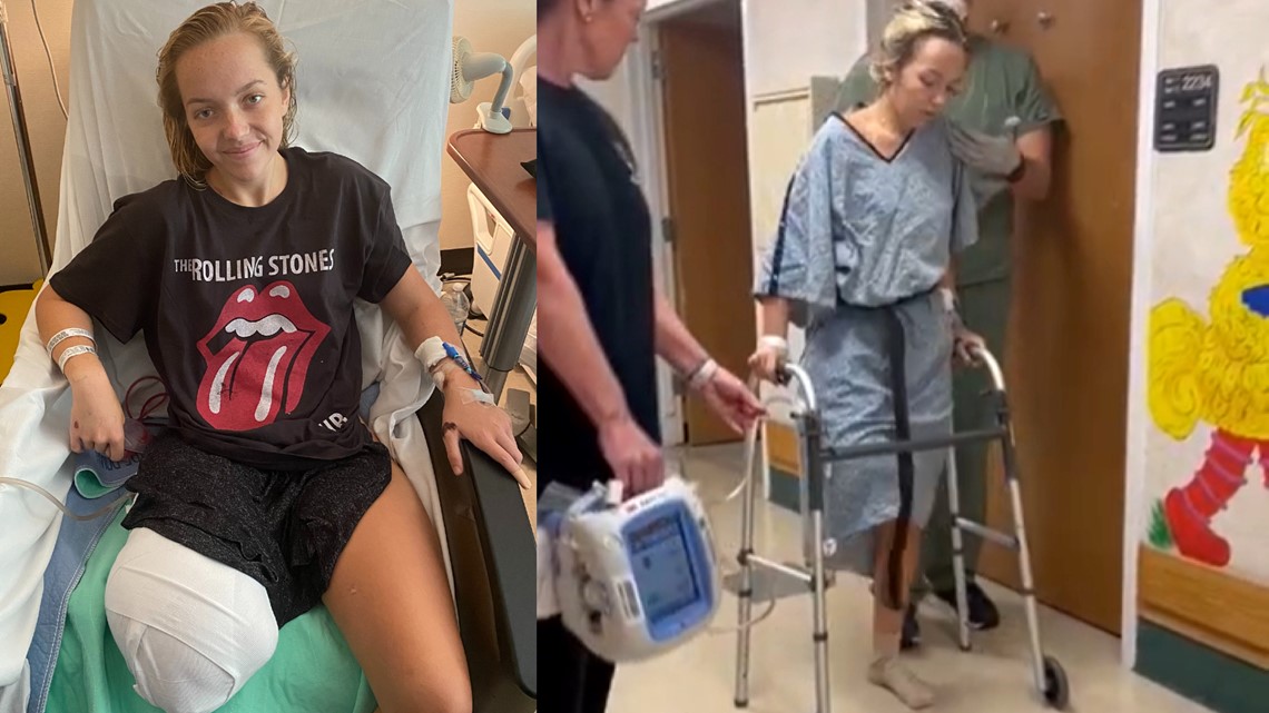 Florida teen takes steps after leg amputated from shark ...