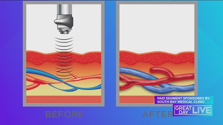 Learn about acoustic wave therapy