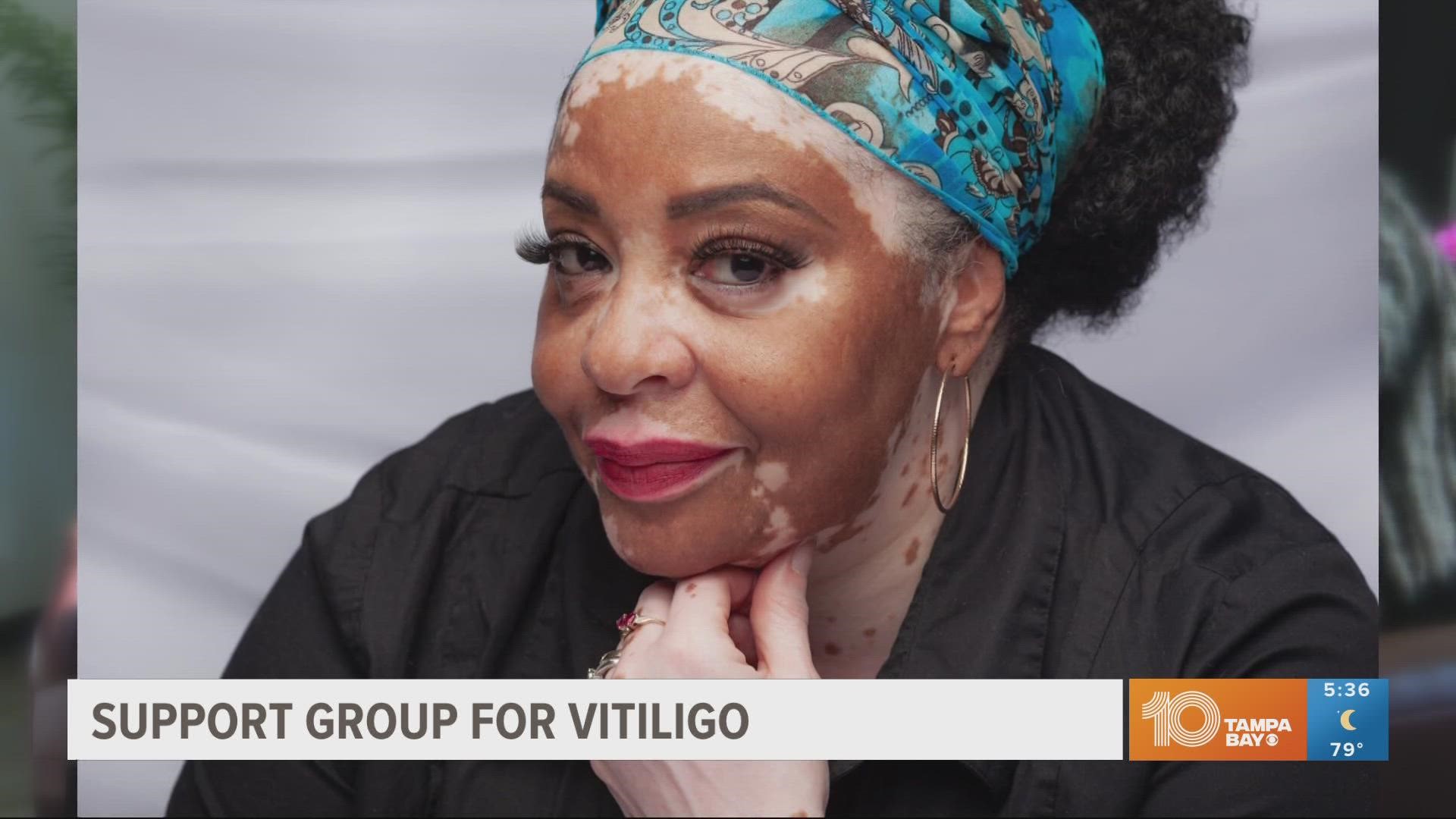 The group aims to educate and reduce the stigma around vitiligo.