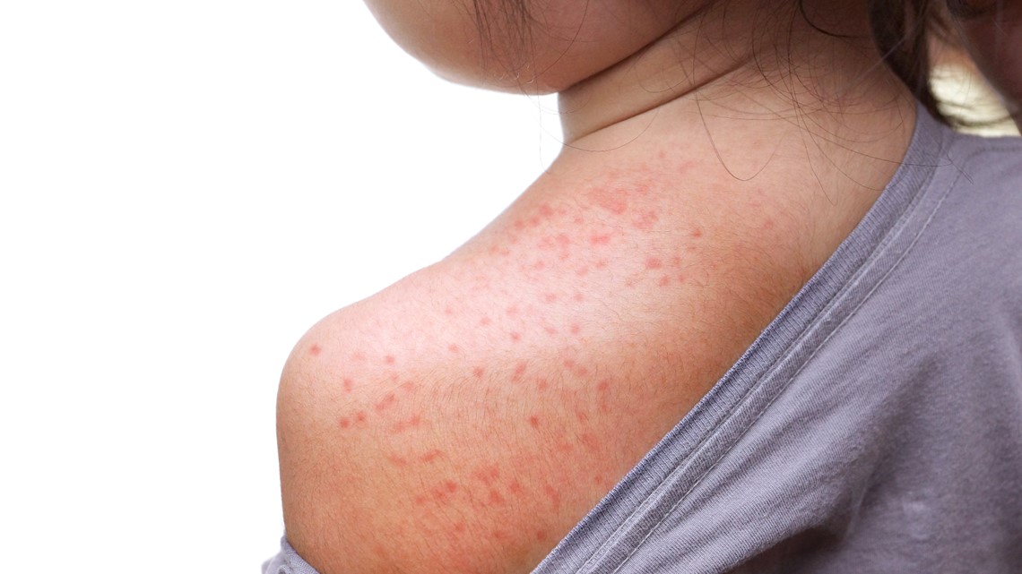 Measles Outbreak at Florida Elementary School Sparks Concern Amid Rising Cases Nationwide