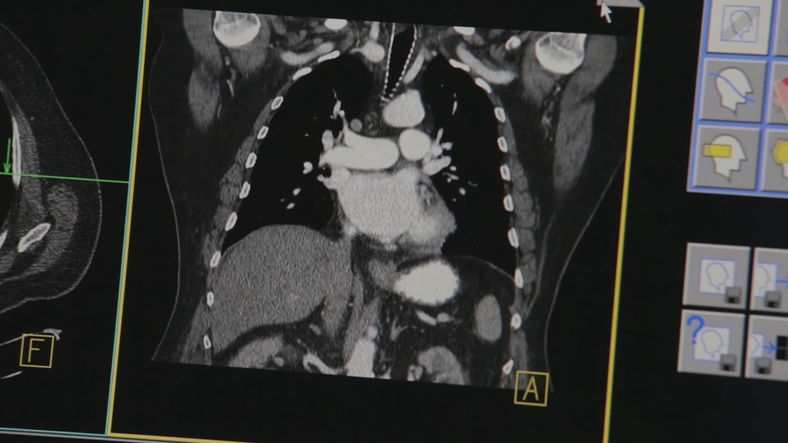 Report reveals low rate of lung cancer screenings in Florida - Vimarsana News