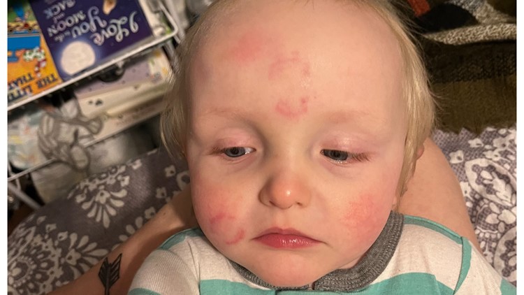 Toddler treated by doctor after being bitten at Georgia daycare